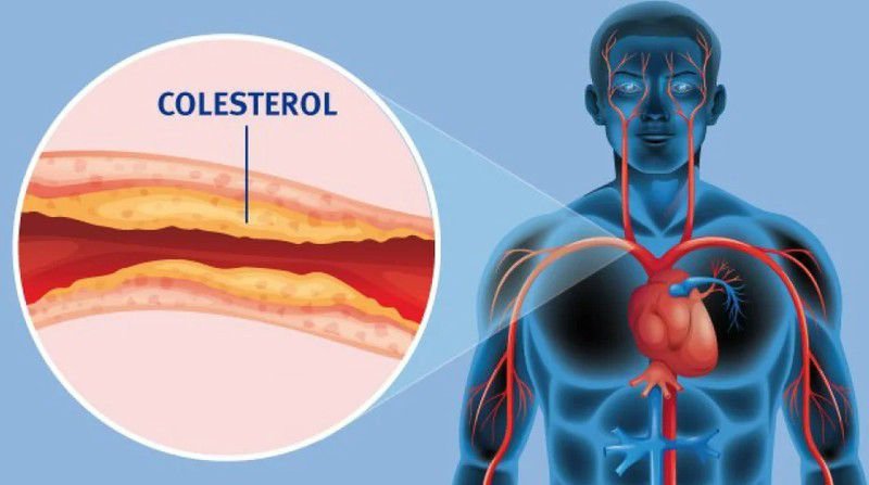 El colesterol alto es un factor de riesgo significativo para enfermedades y accidentes cerebrovasculares.