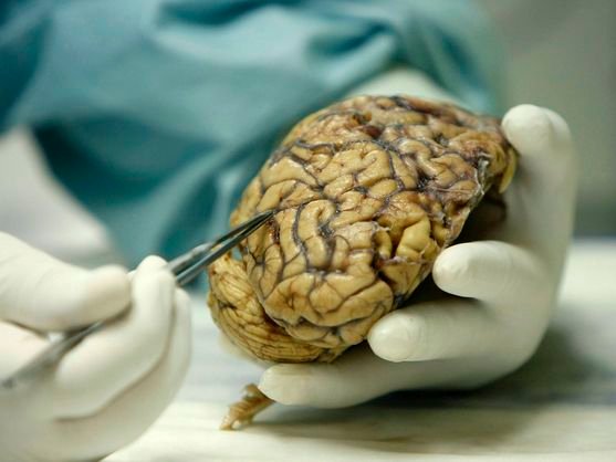 Alzhéimer: un tratamiento experimental ofrece mejoras sostenidas y marca un giro hacia la medicina personalizada