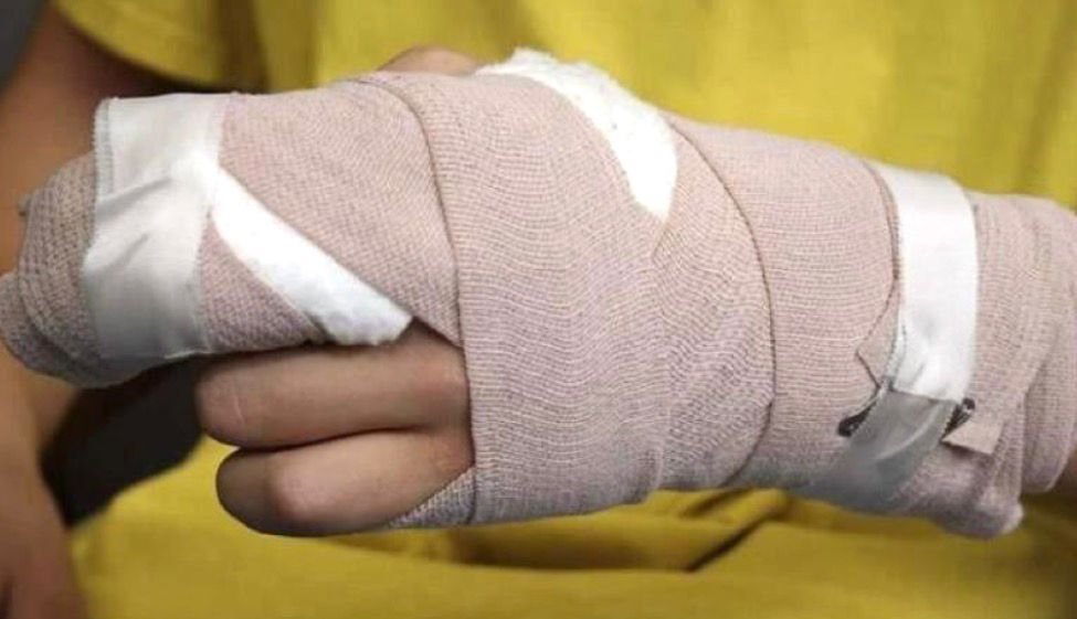 Noche de celebración terminó en emergencia: dos quemados por pólvora en Ibagué